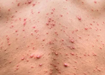 الاتحاد الأوروبي يُحذر من السفر إلى المناطق المتضّررة من فيروس جدري القردة..