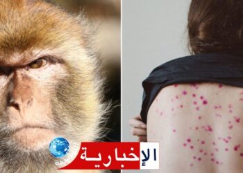 سريع الانتشار: أخصائي يشدد على ضرورة التوقي من عدوى جدري القرود