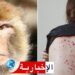 سريع الانتشار: أخصائي يشدد على ضرورة التوقي من عدوى جدري القرود